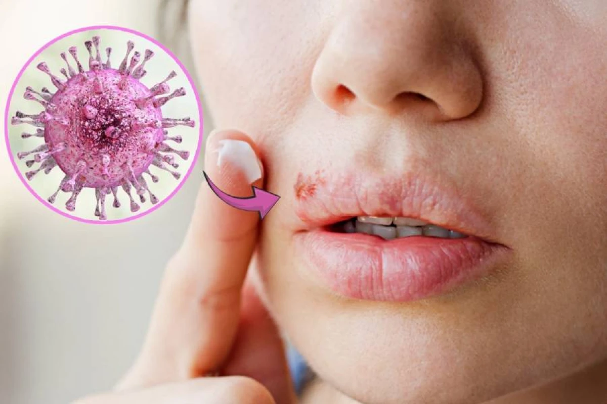 Dodaq herpesinə səbəb olan virus [[Alzheimer riskini artırır]]