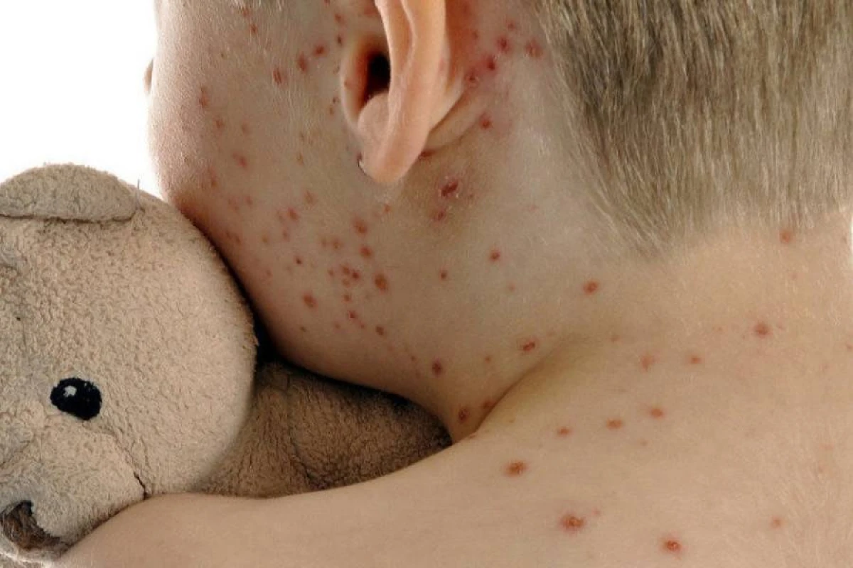 Monqolustanda qızılca epidemiyası [[sürətlə yayılır]]