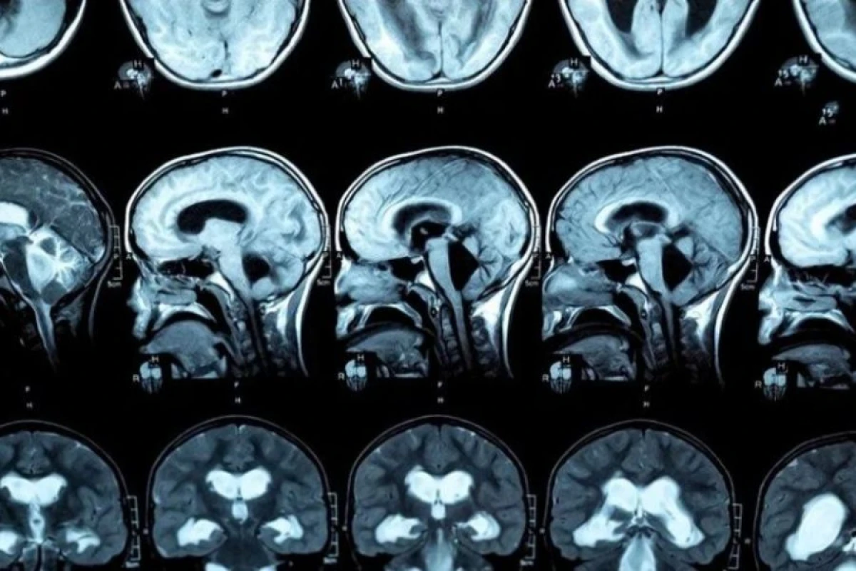 10 faiz beyinlə yaşadı: [[Dünyada ilk]]