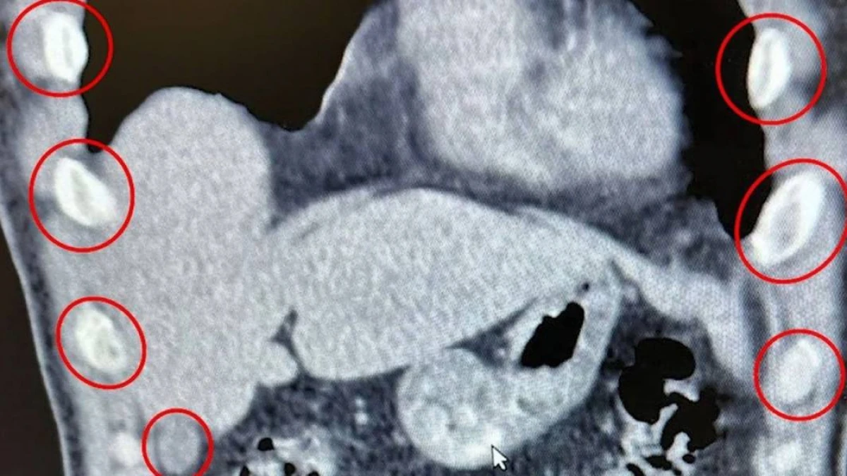 İki şəxsin mədəsindən [[136 kapsul narkotik tapıldı]]