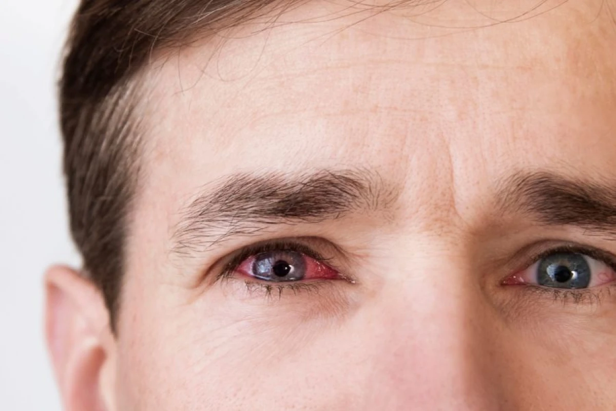 [[“Quru göz sindromu”]] görmə sağlamlığı üçün təhlükə yaradır