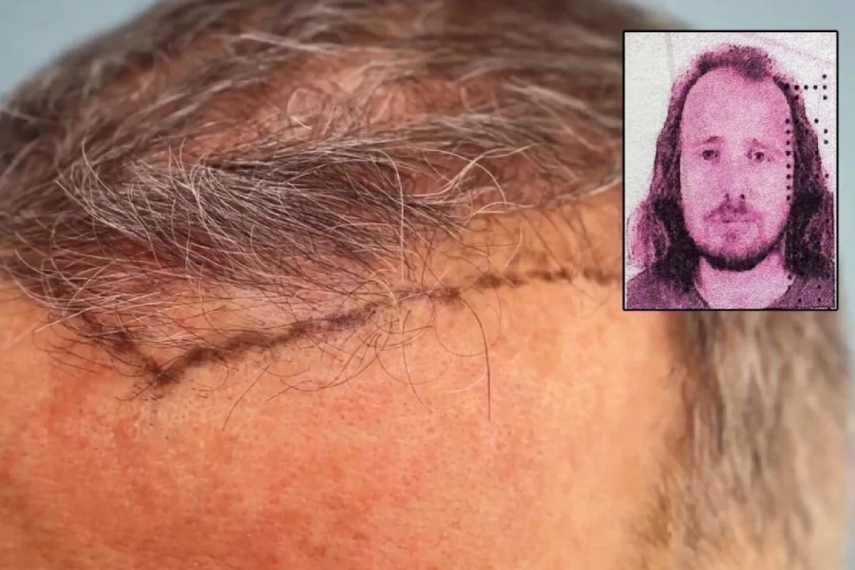 Saç əkdirən şəxs [[öldü]]