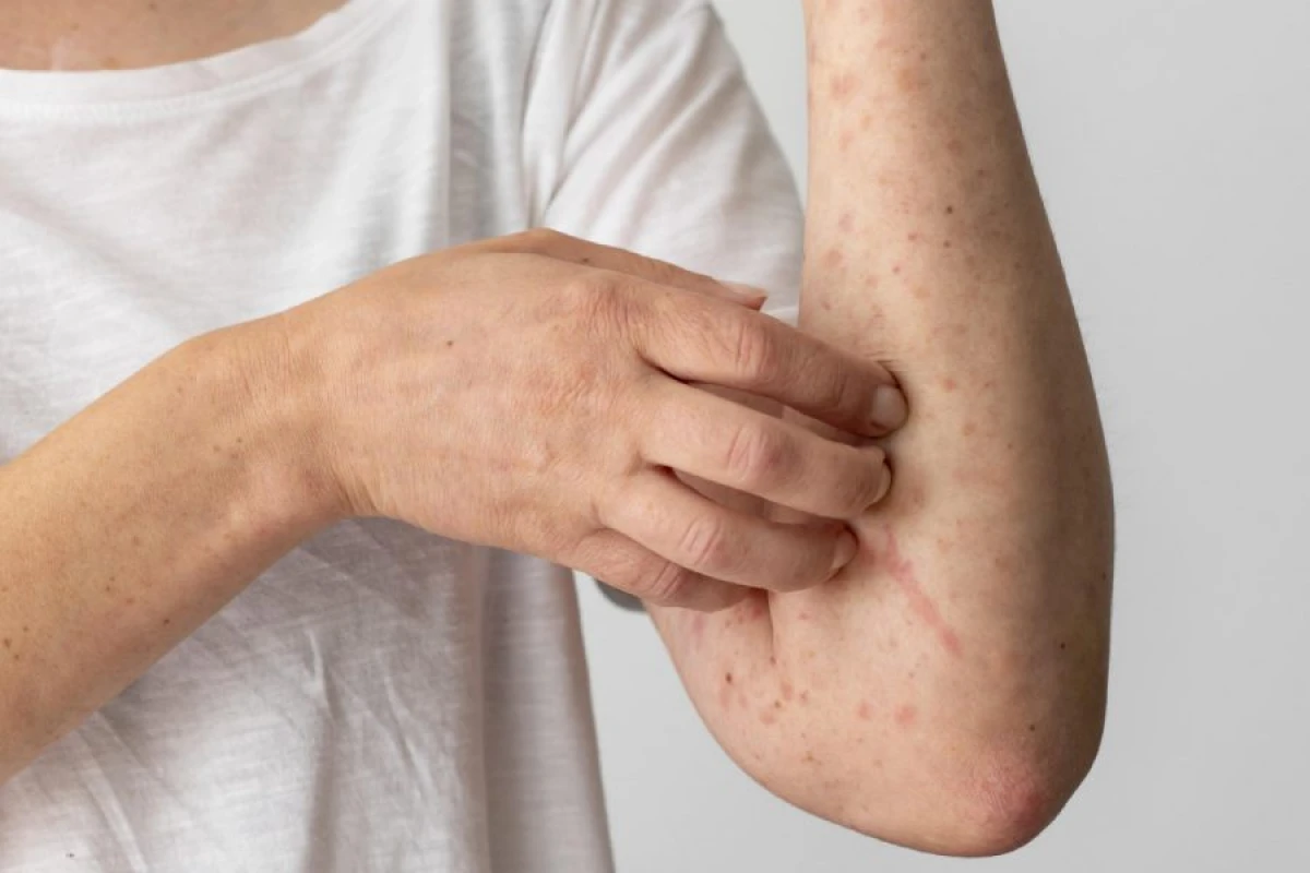 Britaniyada [[qızılca virusu]] yayılır