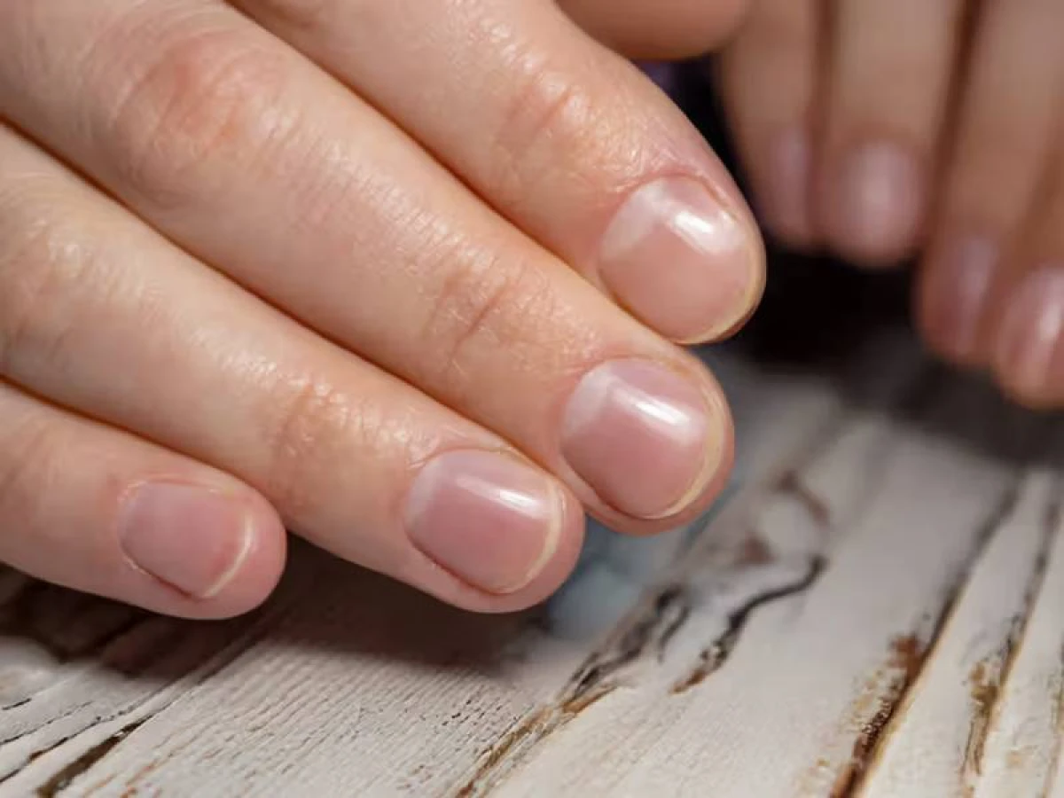 [[Solğun dırnaqlar]] xəstəlik əlaməti ola bilər