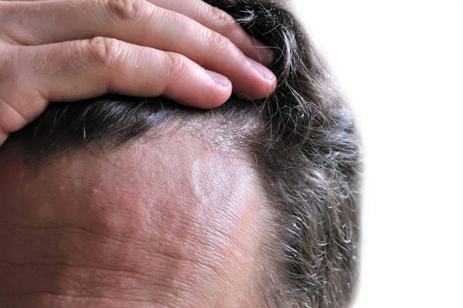 Seboreik dermatit: Əlamətlər hansılardır və necə nəzarətdə saxlamaq olar?