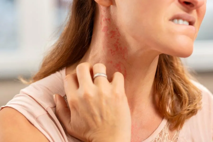 Mövsümi allergiyadan necə qorunmalıyıq? Pollinozun əlamətləri və mübarizə yolları